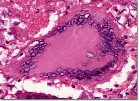 Tuberculinum